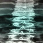 Percutaneous Transpedicular Stabilisation 01