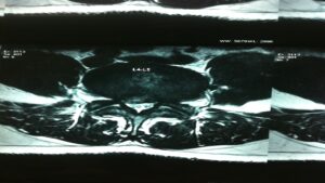 Precutaneous Endoscopic Lumbar Discectomy 02
