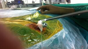 Precutaneous Endoscopic Lumbar Discectomy 03