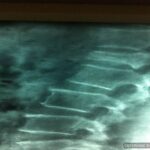 Vertebroplasty 01