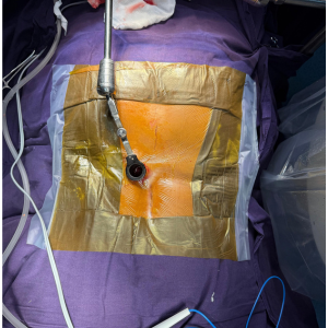 Tubular microscopic surgeries - key hole incisio